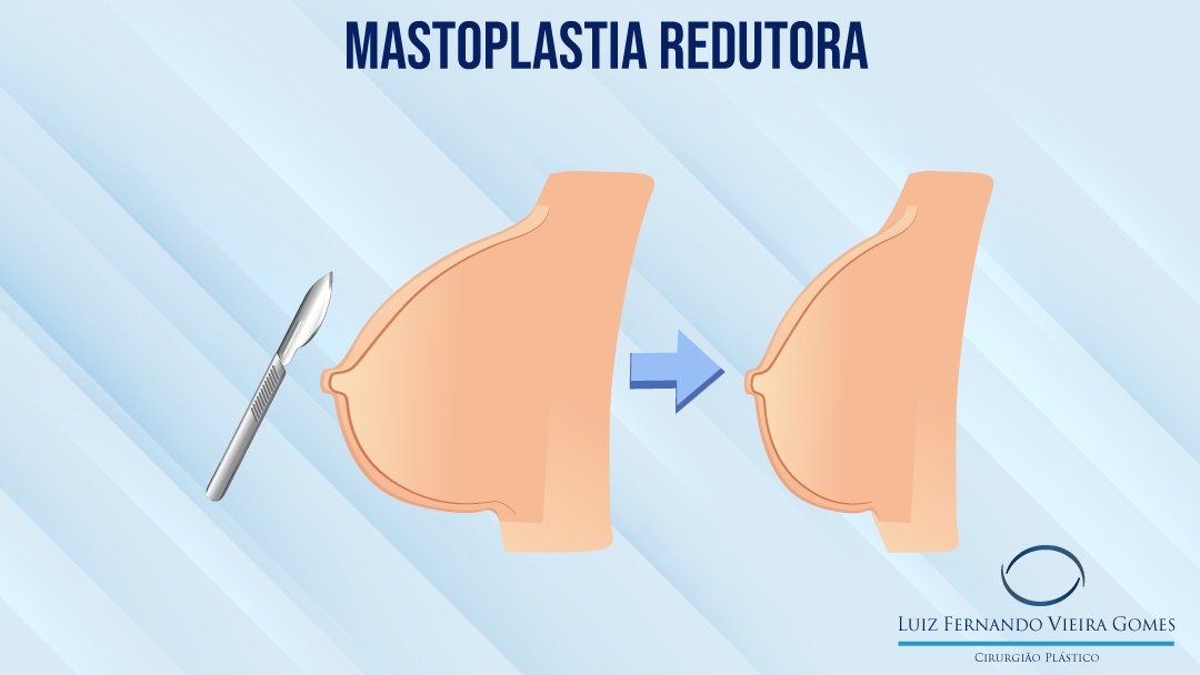 Mastoplastia Redutora